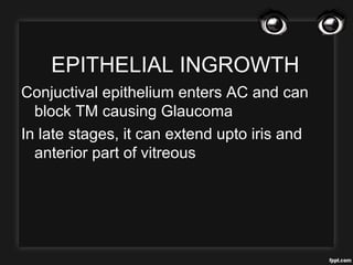 EPITHELIAL INGROWTH
Conjuctival epithelium enters AC and can
block TM causing Glaucoma
In late stages, it can extend upto iris and
anterior part of vitreous
 