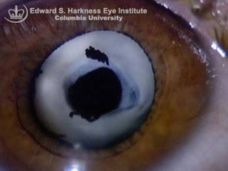 Soemmering’s ring: thick ring behind iris
enclosed between
2 layers of capsule
 