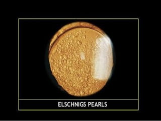 Elschnig’s pearls: vacuolated subcapsular
epithelial cells are
clustered in posterior
capsule
Rx: YAG-laser capsulotomy
 