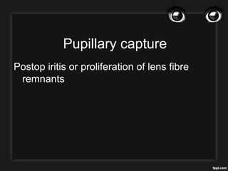 Pupillary capture
Postop iritis or proliferation of lens fibre
remnants
 
