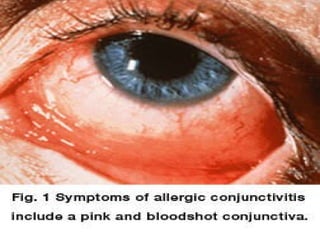 ALLERGIC CONJUCTIVITIS
 
