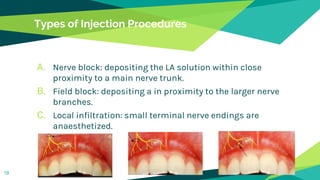 Types of Injection Procedures
A. Nerve block: depositing the LA solution within close
proximity to a main nerve trunk.
B. Field block: depositing a in proximity to the larger nerve
branches.
C. Local infiltration: small terminal nerve endings are
anaesthetized.
19
 
