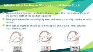 Inferior Alveolar Nerve Block + Lingual Nerve Block
◆ The mandibular foramen is situated at a level lower than the occlusal plane of
the primary teeth of the paediatric patient.
◆ The injection must be made slightly lower and more posteriorly than for an adult
patient
◆ The depth of insertion should be 15 mm approx. and around I ml of solution
must be deposited.
24
Before 6
years
6- 12
years
After 12
years
 