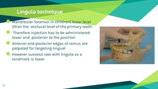 Lingula technique
◆ Mandibular foramen in children( lower level
)than the occlusal level of the primary teeth
◆ Therefore injection has to be administered
lower and posterior to the position
◆ Anterior and posterior edges of ramus are
palpated for targeting lingual
◆ However success rate with lingula as a
landmark is lower
30
 