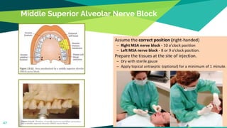 Middle Superior Alveolar Nerve Block
47
 