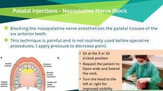 Palatal injections - Nasoplatine Nerve Block
◆ Blocking the nasopalatine nerve anesthetizes the palatal tissues of the
six anterior teeth.
◆ This technique is painful and is not routinely used before operative
procedures. ( apply pressure to decrease pain).
49
 