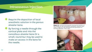 Intraosseous Injection:
◆ Require the deposition of local
anesthetic solution in the porous
alveolar bone.
◆ By forcing a needle through the
cortical plate and into the
cancellous alveolar bone Or a
small, round bur may be used to
make an access in the bone for
the needle.
52
 