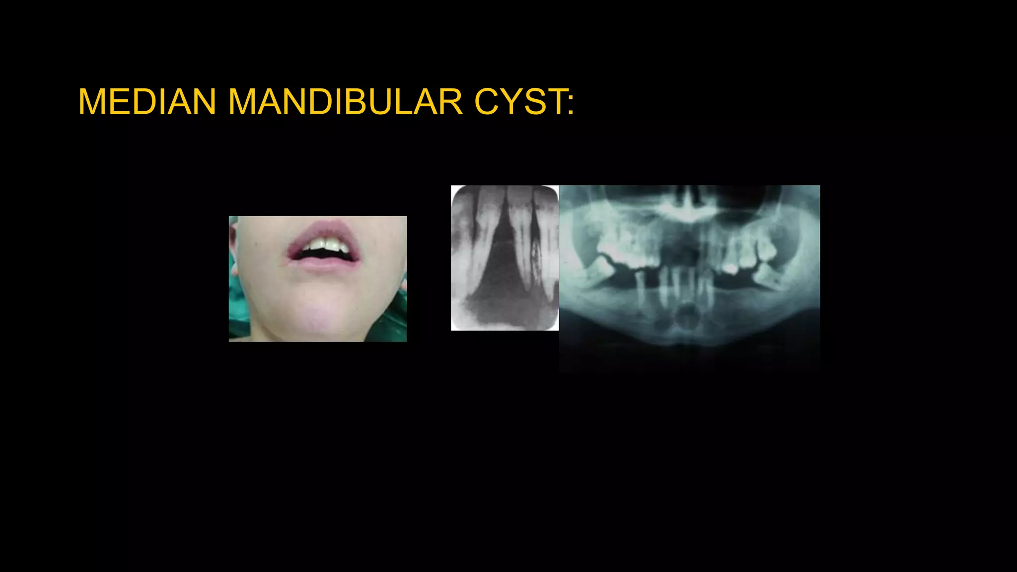 MEDIAN MANDIBULAR CYST:
 