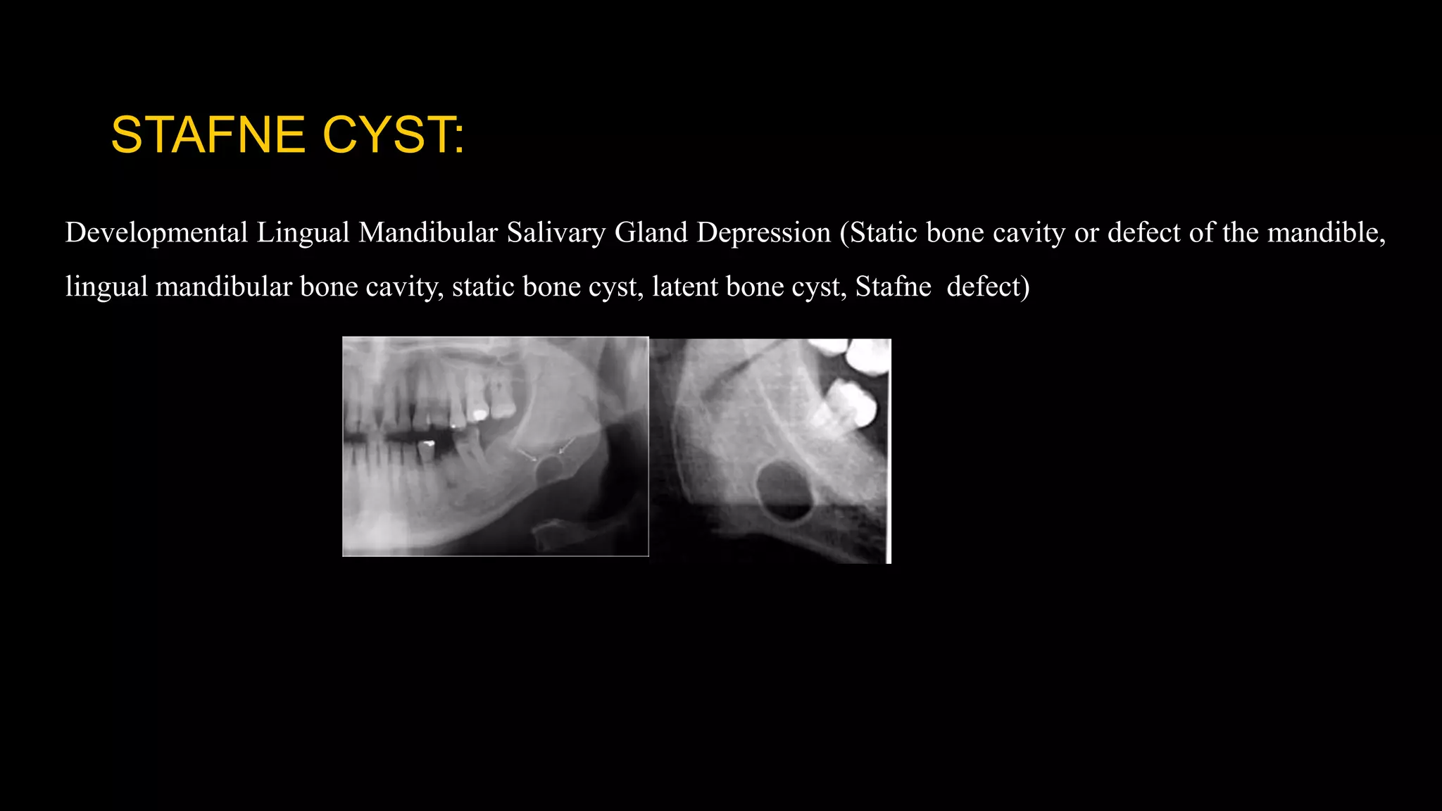 STAFNE CYST:
Developmental Lingual Mandibular Salivary Gland Depression (Static bone cavity or defect of the mandible,
lingual mandibular bone cavity, static bone cyst, latent bone cyst, Stafne defect)
 