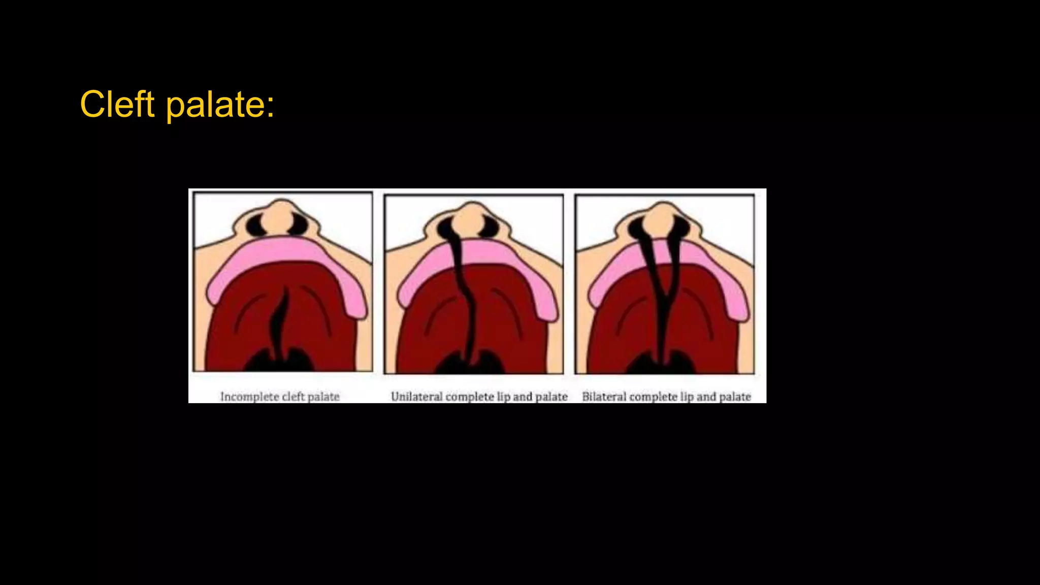 Cleft palate:
 