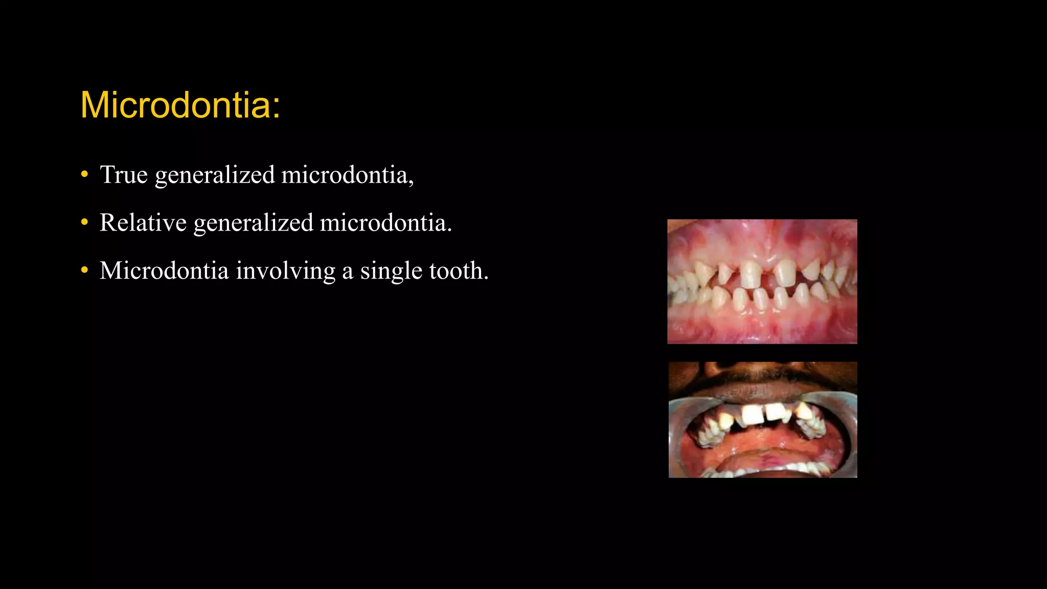 Microdontia:
• True generalized microdontia,
• Relative generalized microdontia.
• Microdontia involving a single tooth.
 