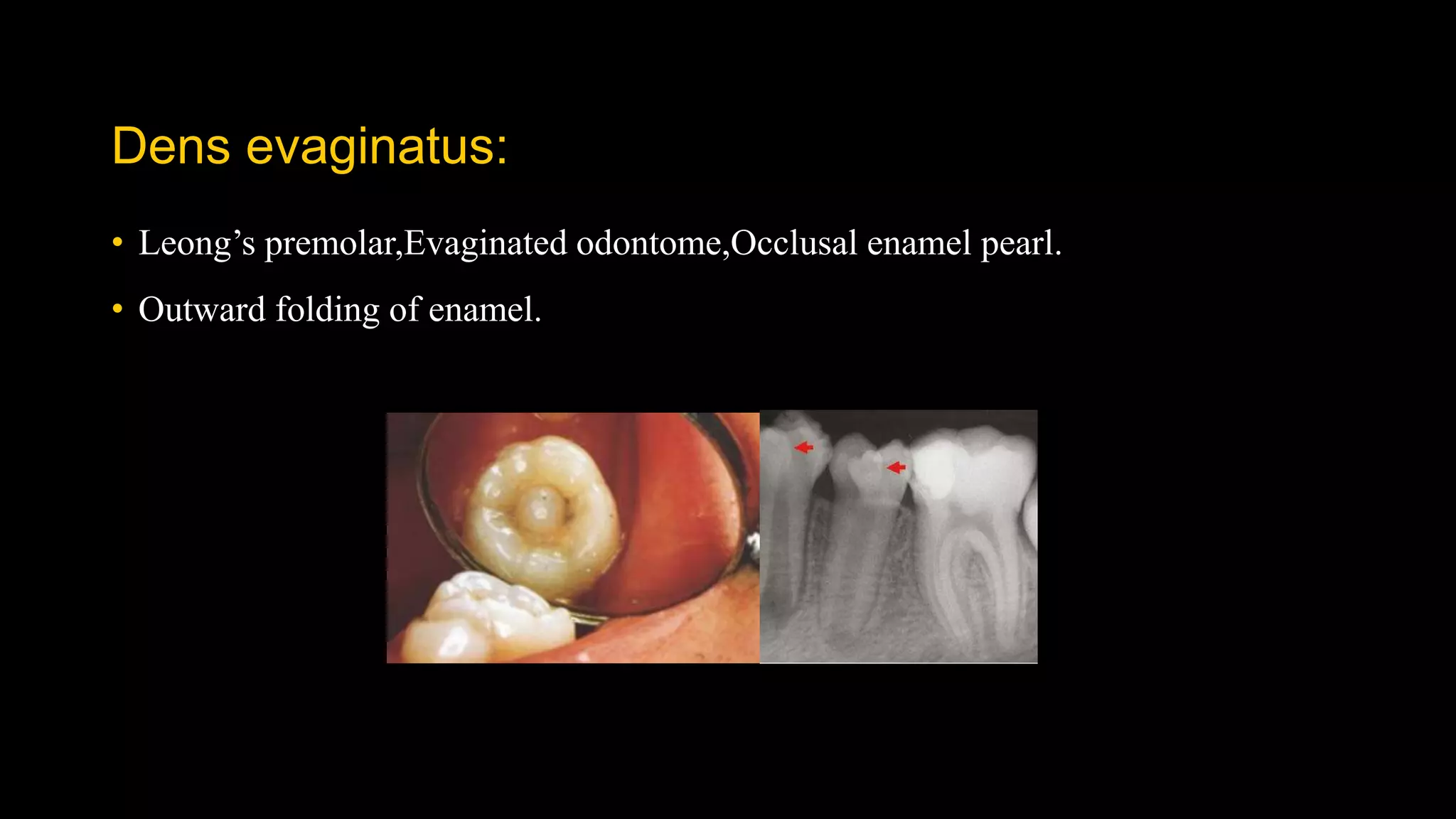 Dens evaginatus:
• Leong’s premolar,Evaginated odontome,Occlusal enamel pearl.
• Outward folding of enamel.
 