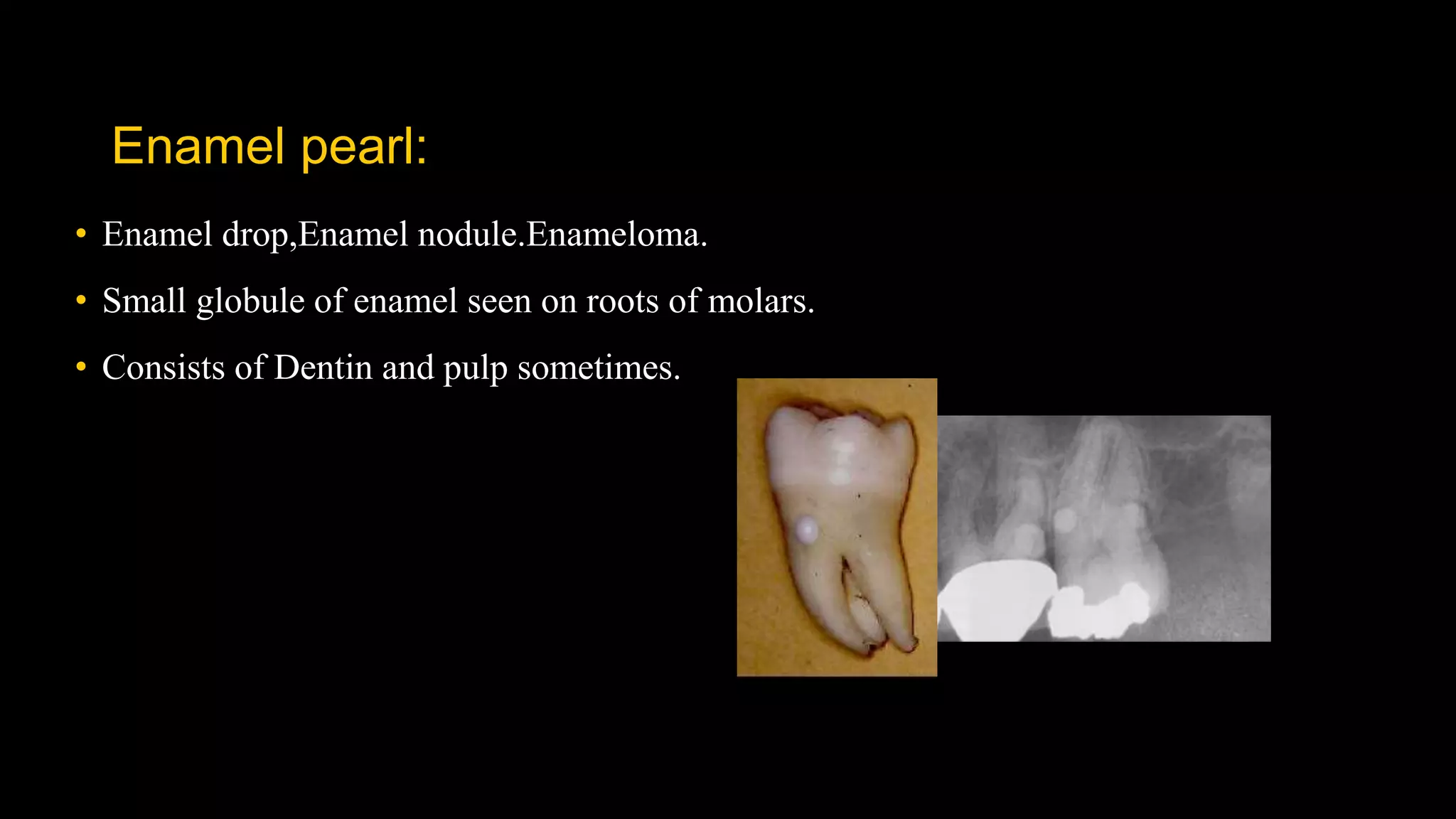 Enamel pearl:
• Enamel drop,Enamel nodule.Enameloma.
• Small globule of enamel seen on roots of molars.
• Consists of Dentin and pulp sometimes.
 