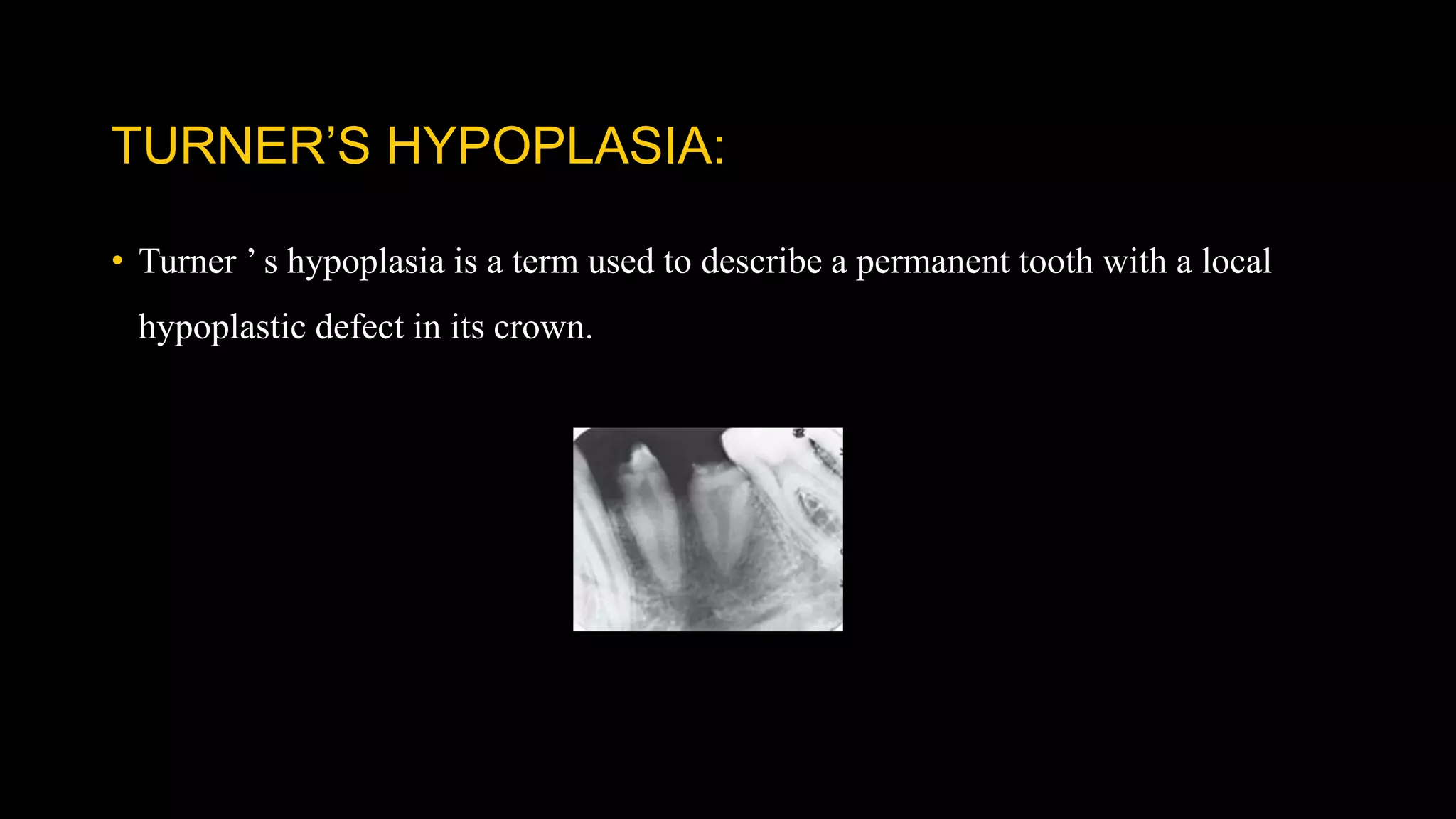 TURNER’S HYPOPLASIA:
• Turner ’ s hypoplasia is a term used to describe a permanent tooth with a local
hypoplastic defect in its crown.
 