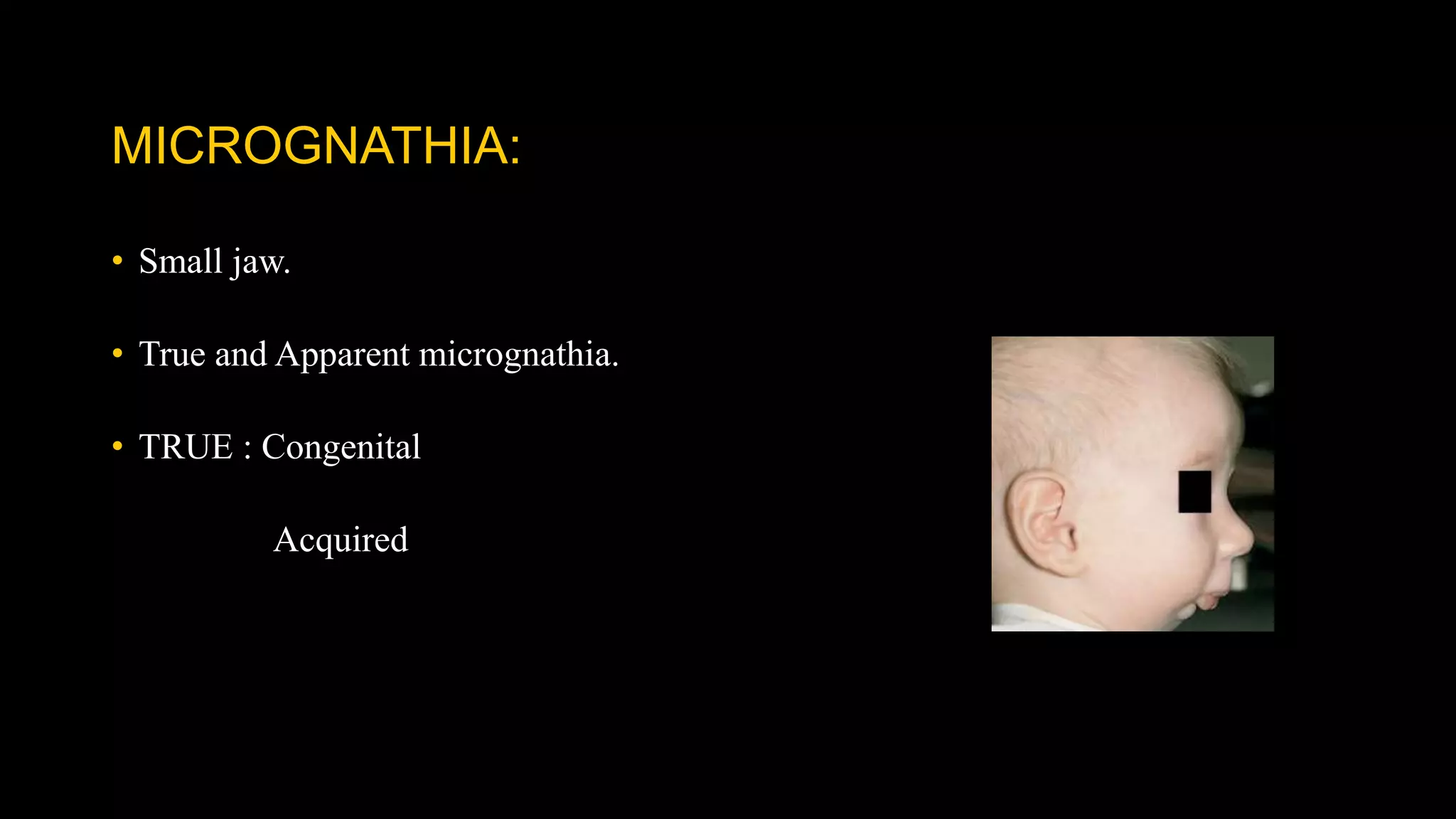 MICROGNATHIA:
• Small jaw.
• True and Apparent micrognathia.
• TRUE : Congenital
Acquired
 