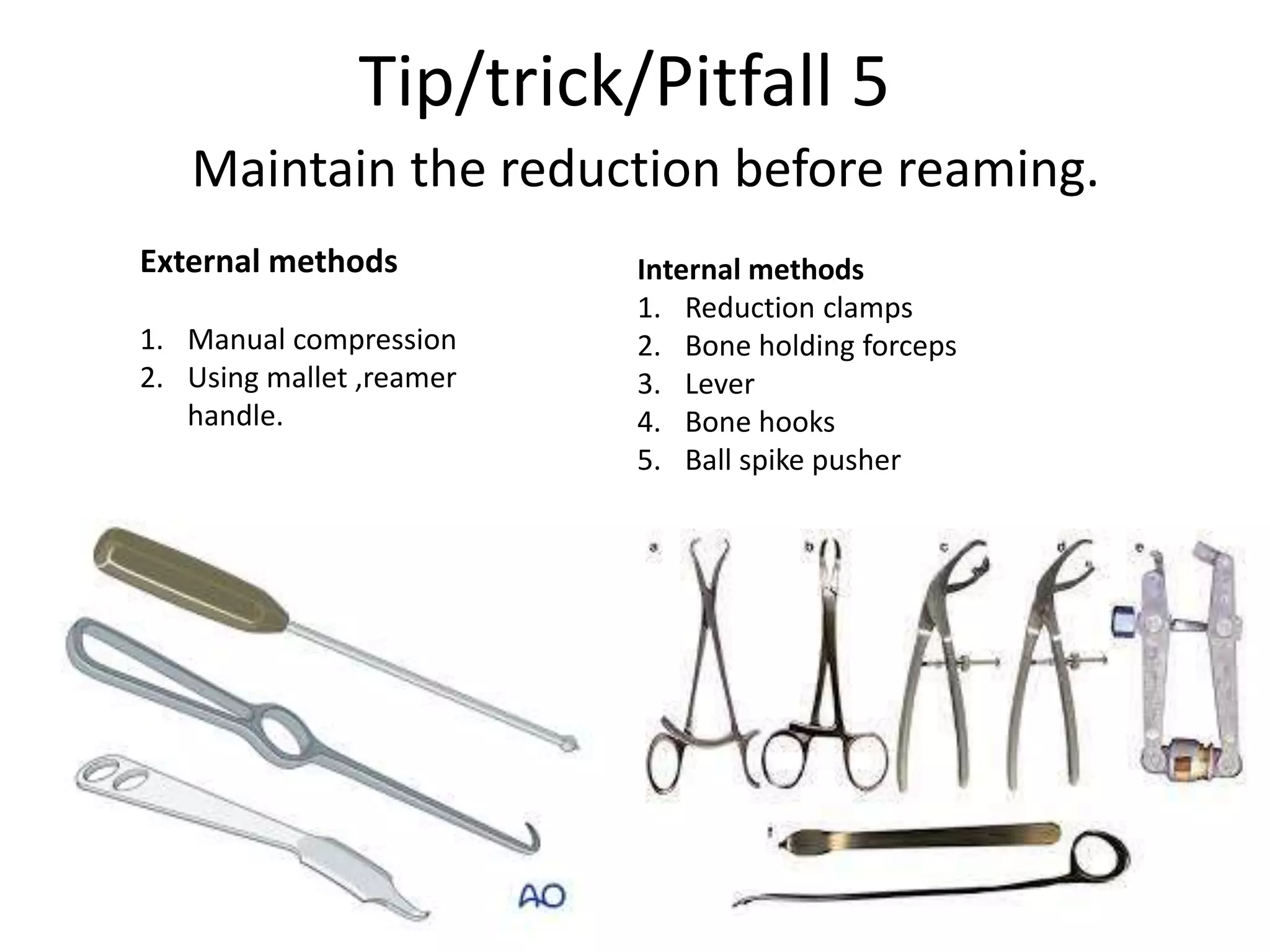 Tip/trick/Pitfall 5
Maintain the reduction before reaming.
External methods
1. Manual compression
2. Using mallet ,reamer
handle.
Internal methods
1. Reduction clamps
2. Bone holding forceps
3. Lever
4. Bone hooks
5. Ball spike pusher
 