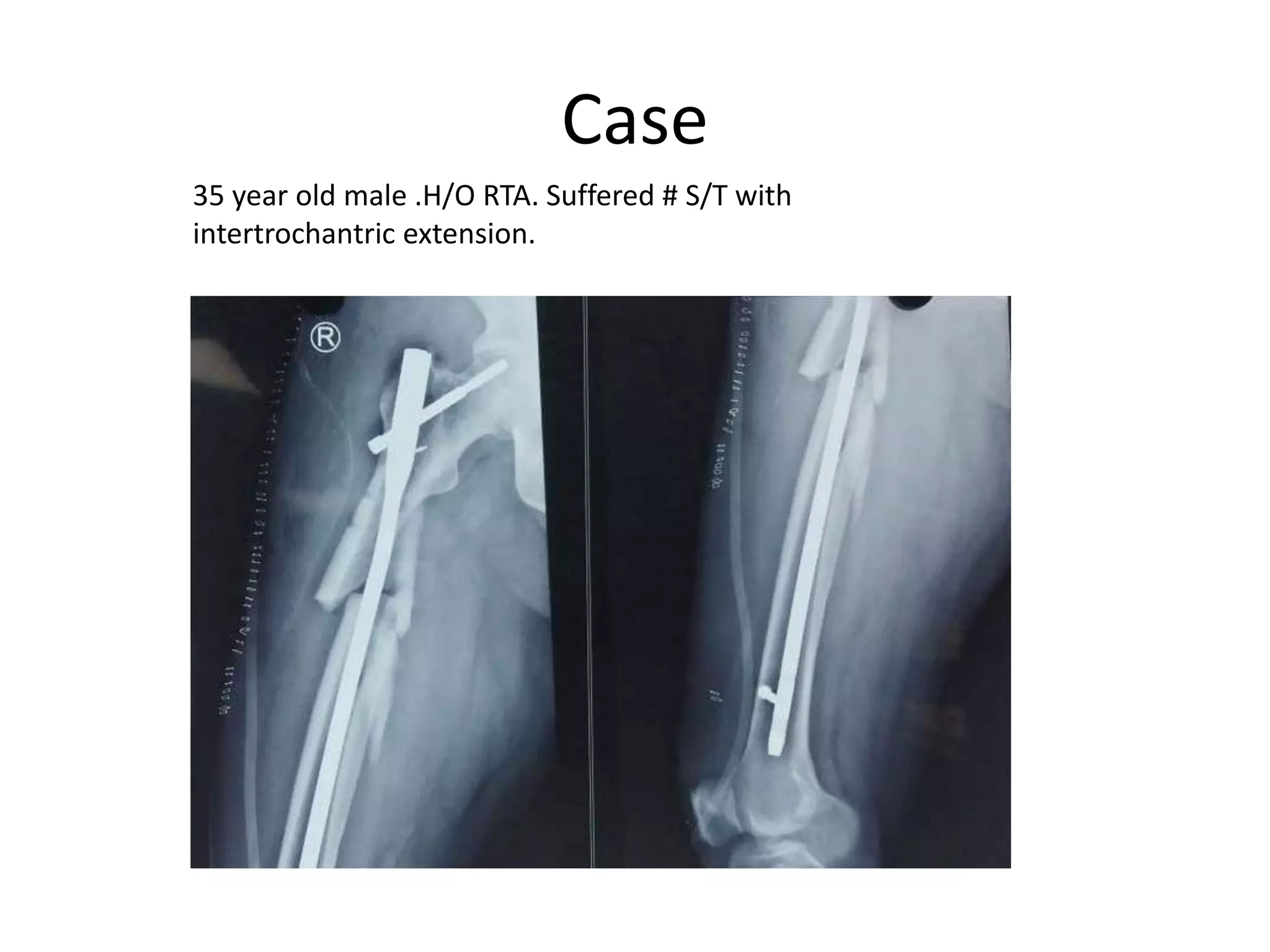 Case
35 year old male .H/O RTA. Suffered # S/T with
intertrochantric extension.
 