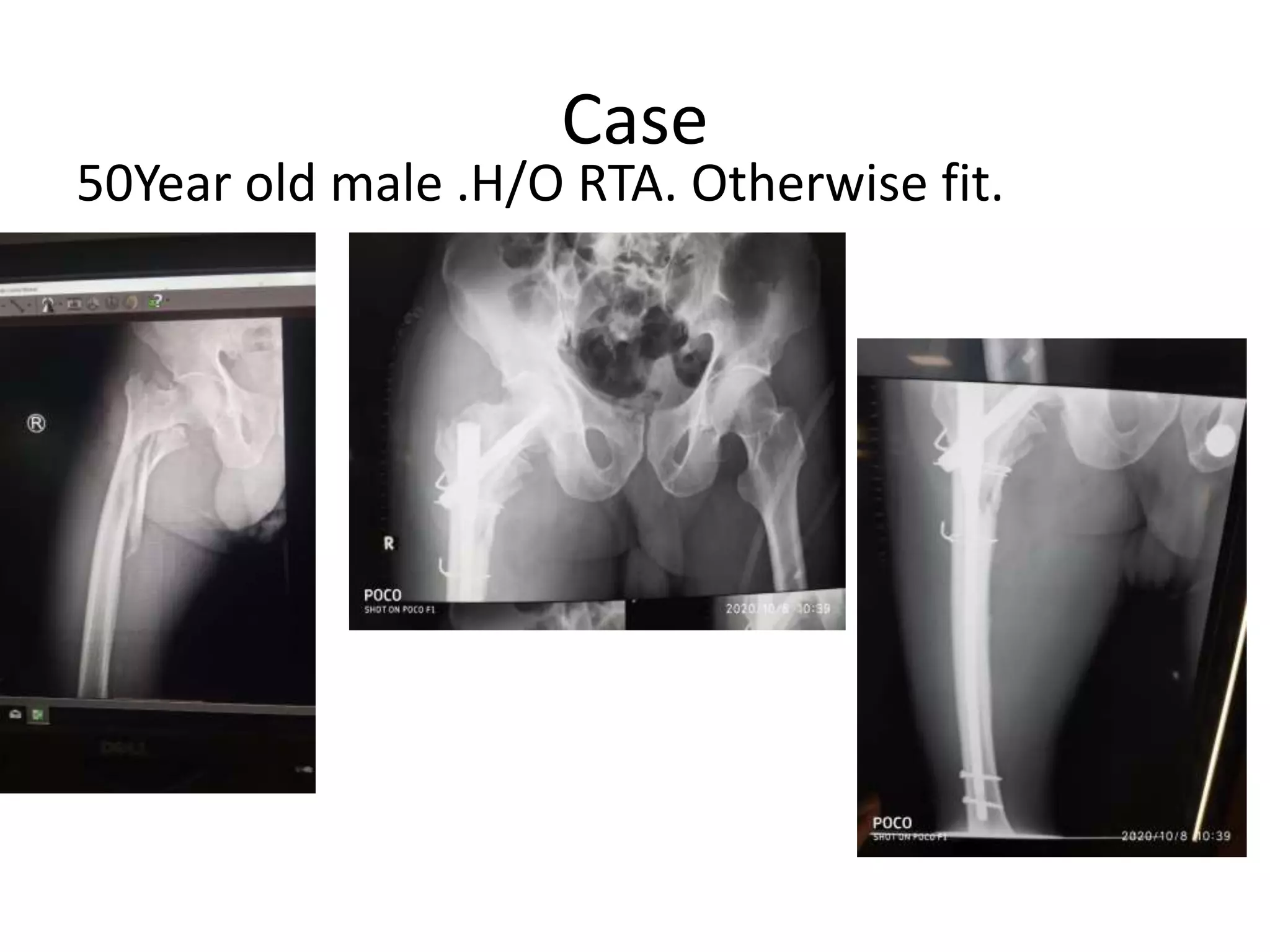 Case
50Year old male .H/O RTA. Otherwise fit.
 