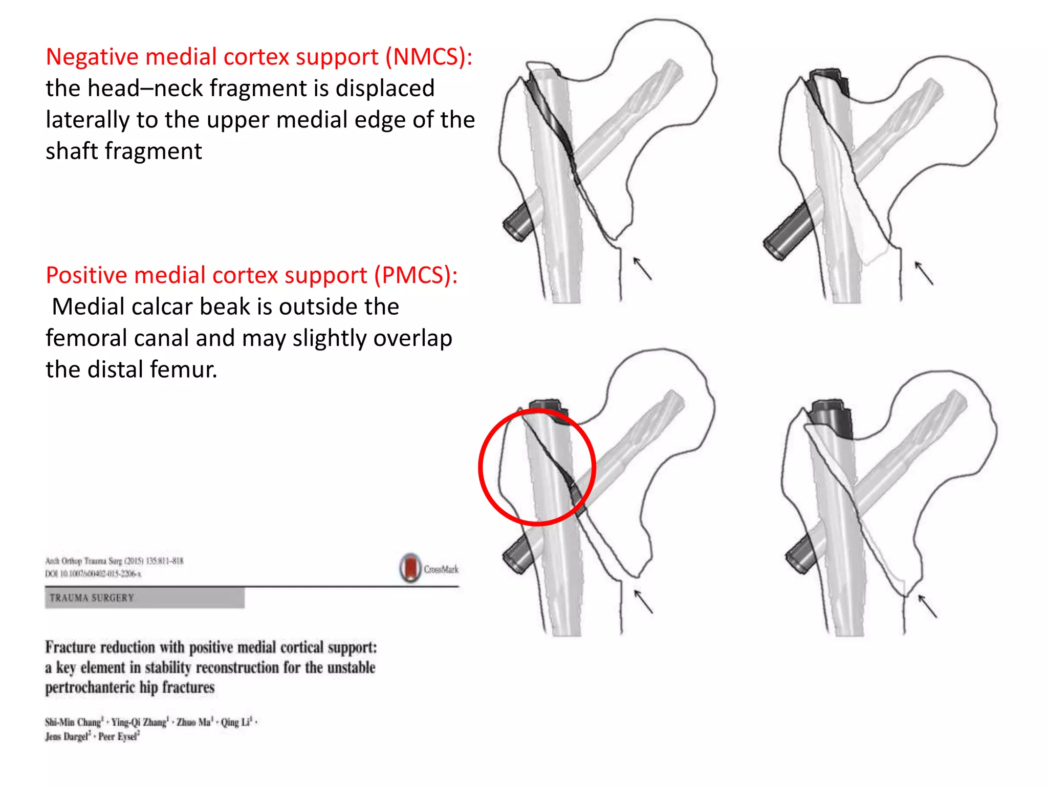 Positive medial cortex support (PMCS):
Medial calcar beak is outside the
femoral canal and may slightly overlap
the distal femur.
Negative medial cortex support (NMCS):
the head–neck fragment is displaced
laterally to the upper medial edge of the
shaft fragment
 