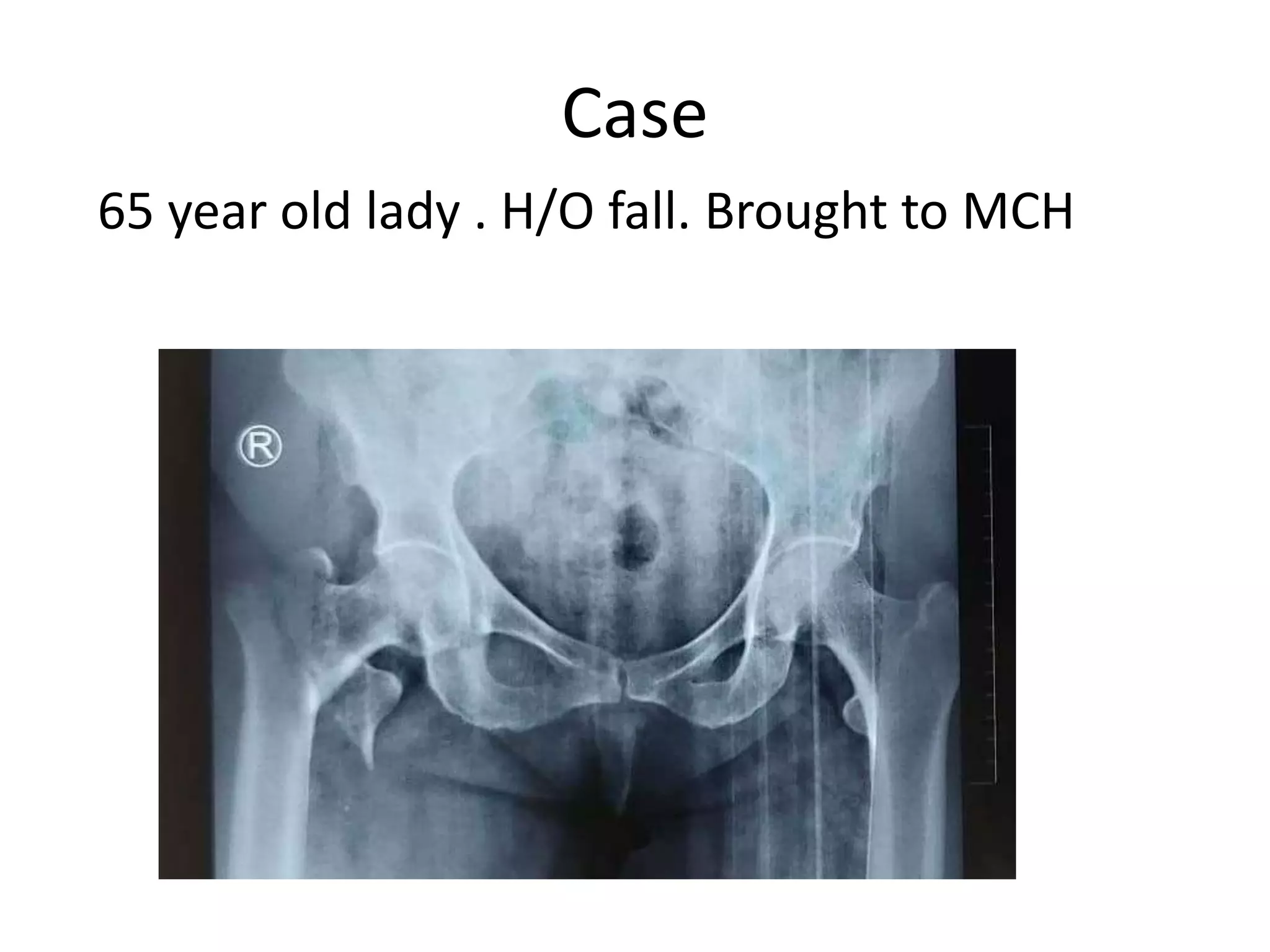 65 year old lady . H/O fall. Brought to MCH
Case
 