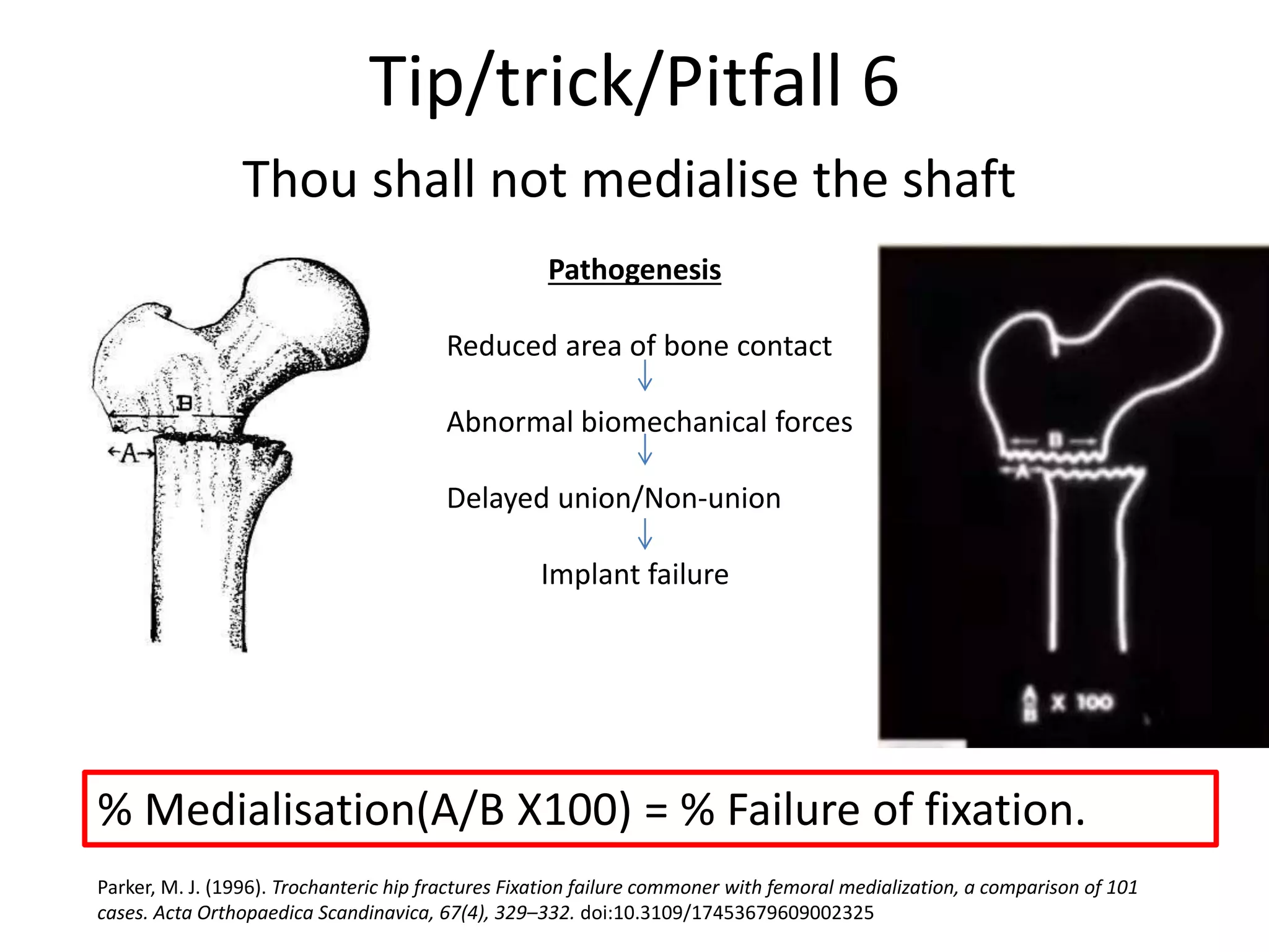 Tip/trick/Pitfall 6
Thou shall not medialise the shaft
Pathogenesis
Reduced area of bone contact
Abnormal biomechanical forces
Delayed union/Non-union
Implant failure
% Medialisation(A/B X100) = % Failure of fixation.
Parker, M. J. (1996). Trochanteric hip fractures Fixation failure commoner with femoral medialization, a comparison of 101
cases. Acta Orthopaedica Scandinavica, 67(4), 329–332. doi:10.3109/17453679609002325
 
