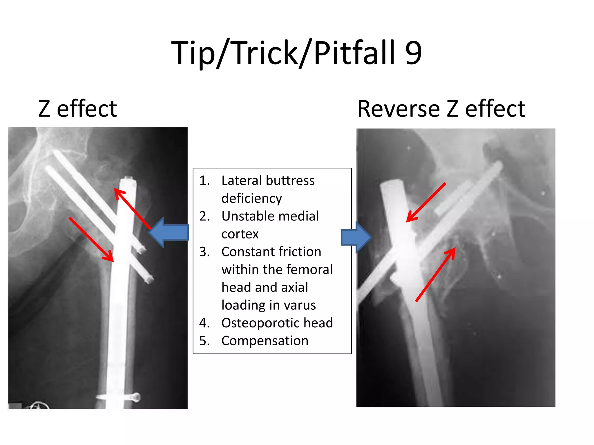Tip/Trick/Pitfall 9
Z effect Reverse Z effect
1. Lateral buttress
deficiency
2. Unstable medial
cortex
3. Constant friction
within the femoral
head and axial
loading in varus
4. Osteoporotic head
5. Compensation
 