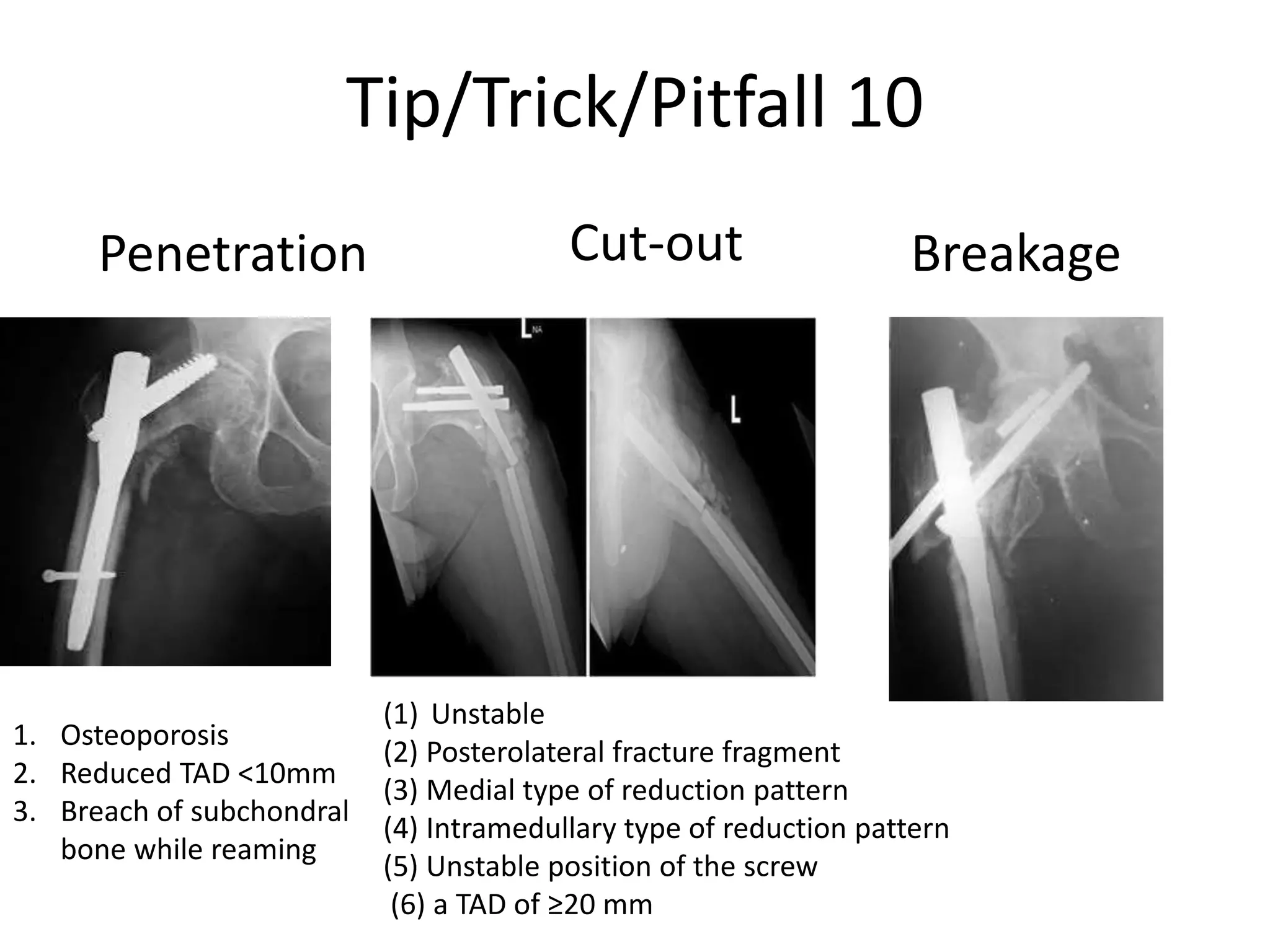 Tip/Trick/Pitfall 10
Penetration
(1) Unstable
(2) Posterolateral fracture fragment
(3) Medial type of reduction pattern
(4) Intramedullary type of reduction pattern
(5) Unstable position of the screw
(6) a TAD of ≥20 mm
Cut-out Breakage
1. Osteoporosis
2. Reduced TAD <10mm
3. Breach of subchondral
bone while reaming
 