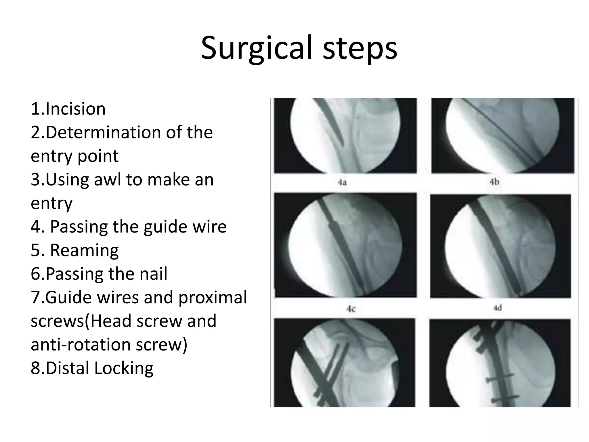 Surgical steps
1.Incision
2.Determination of the
entry point
3.Using awl to make an
entry
4. Passing the guide wire
5. Reaming
6.Passing the nail
7.Guide wires and proximal
screws(Head screw and
anti-rotation screw)
8.Distal Locking
 