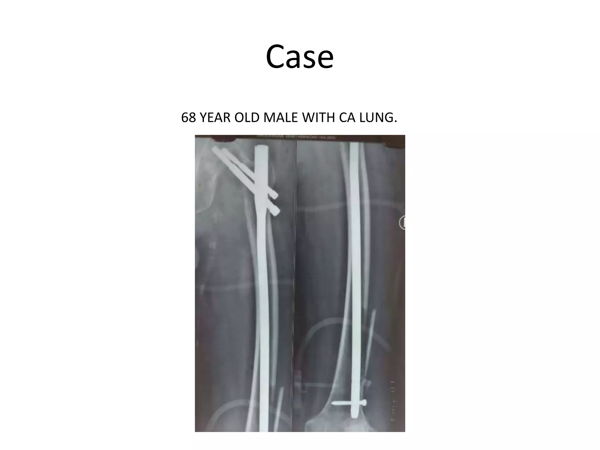 Case
68 YEAR OLD MALE WITH CA LUNG.
 