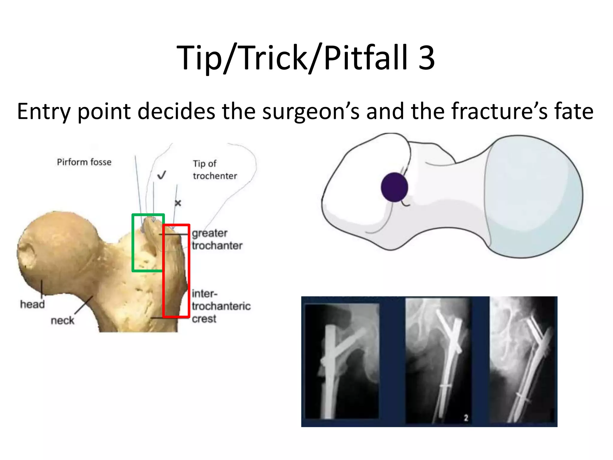 Tip/Trick/Pitfall 3
Entry point decides the surgeon’s and the fracture’s fate
 
