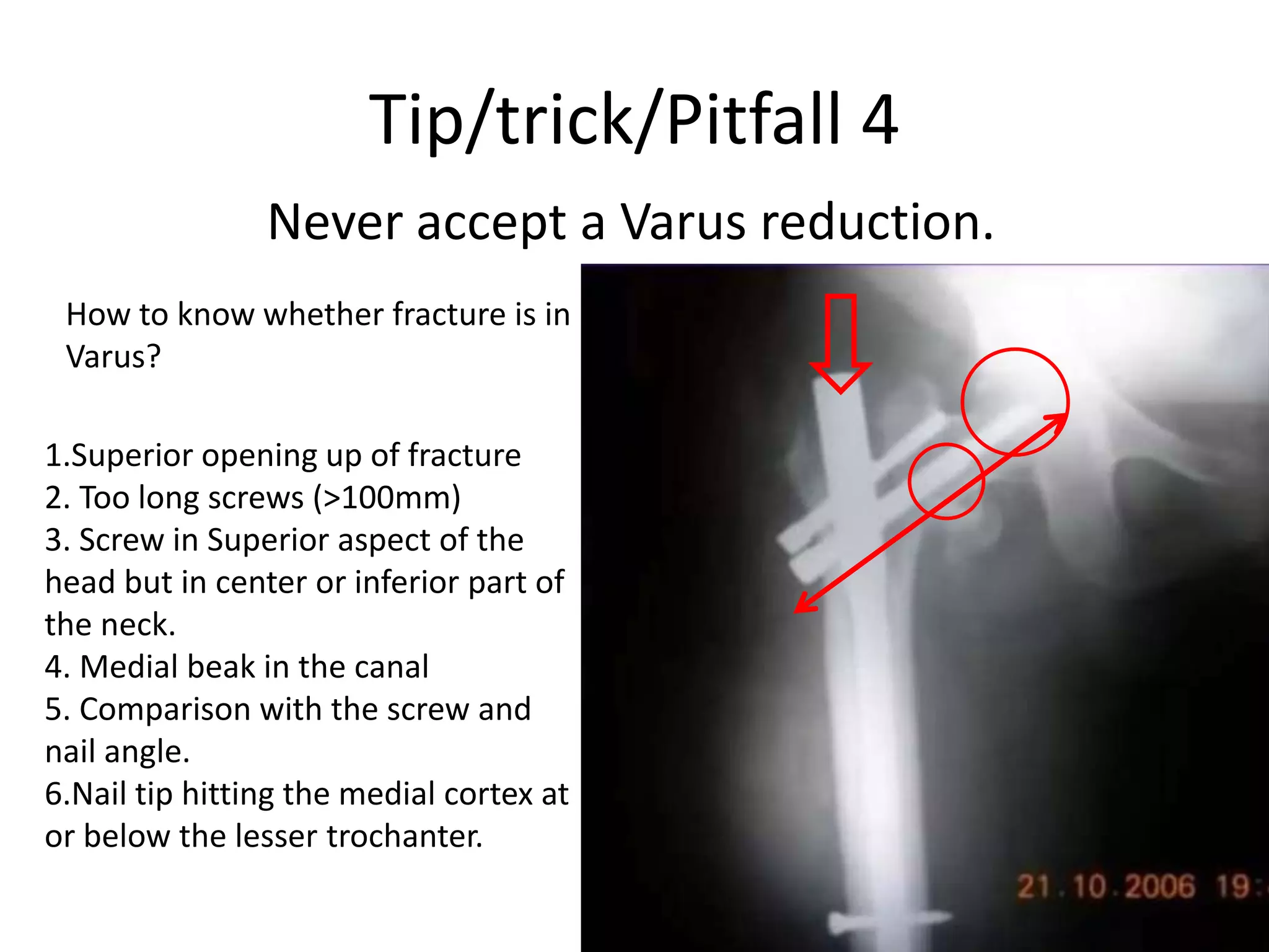 Tip/trick/Pitfall 4
Never accept a Varus reduction.
How to know whether fracture is in
Varus?
1.Superior opening up of fracture
2. Too long screws (>100mm)
3. Screw in Superior aspect of the
head but in center or inferior part of
the neck.
4. Medial beak in the canal
5. Comparison with the screw and
nail angle.
6.Nail tip hitting the medial cortex at
or below the lesser trochanter.
 