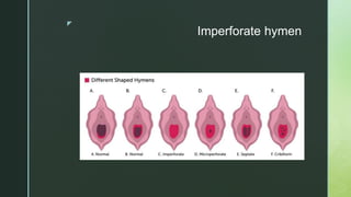 z
Imperforate hymen
 