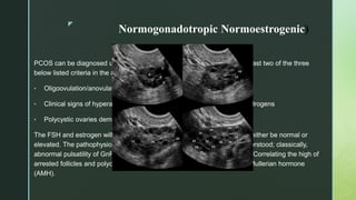 z
Normogonadotropic Normoestrogenic)
PCOS can be diagnosed using the Rotterdam criteria, which requires at least two of the three
below listed criteria in the absence of other pathological causes
• Oligoovulation/anovulation
• Clinical signs of hyperandrogenism and/or serological elevations of androgens
• Polycystic ovaries demonstrated with ultrasound
The FSH and estrogen will be within normal laboratory limits. The LH can either be normal or
elevated. The pathophysiology behind PCOS and infertility is not well understood; classically,
abnormal pulsatility of GnRH is described as a possible underlying cause. Correlating the high of
arrested follicles and polycystic appearing ovaries is the elevation of anti-Mullerian hormone
(AMH).
 