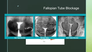 z
Fallopian Tube Blockage
 