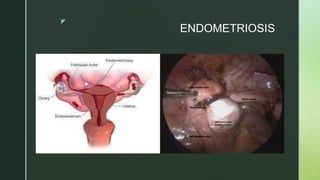 z
ENDOMETRIOSIS
 