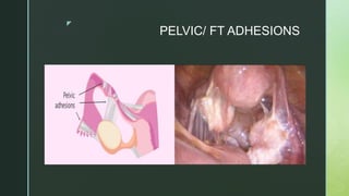 z
PELVIC/ FT ADHESIONS
 