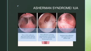 z
ASHERMAN SYNDROME/ IUA
 