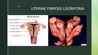 z
UTERINE FIBROID/ LEIOMYOMA
 