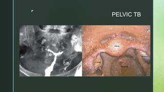 z
PELVIC TB
 