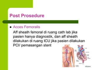  Acces Femoralis
Aff sheath femoral di ruang cath lab jika
pasien hanya diagnostik, dan aff sheath
dilakukan di ruang ICU...