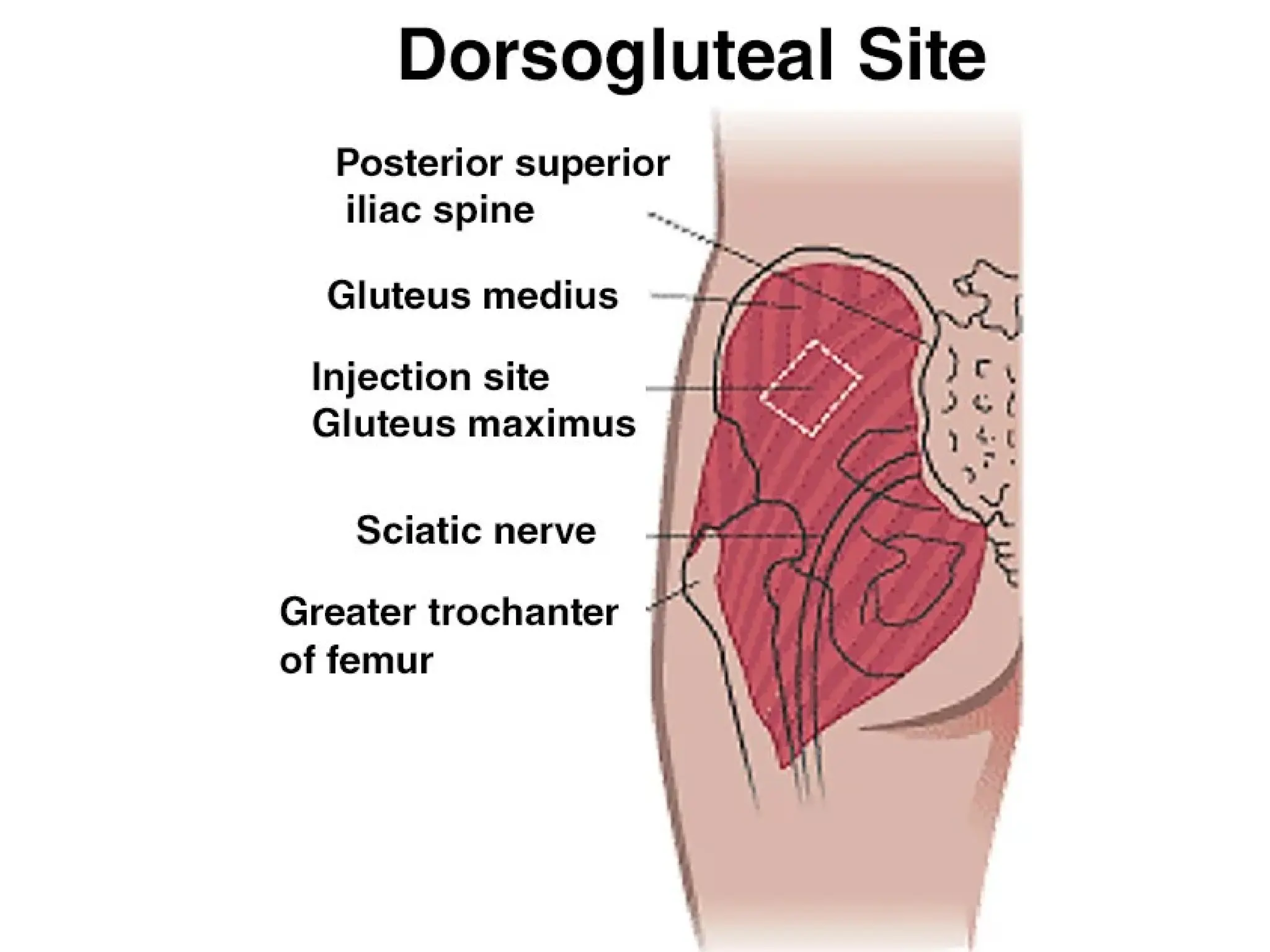 Glute Injection Ppt- axial and appendicular skeleton, injection sites | PPT
