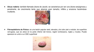 Ulcus Rodems ppt-carcinoma-basocelular.pptx DIAPOSITIVAS | PPTX