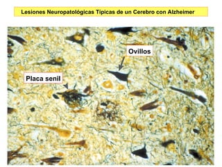 Lesiones Neuropatológicas Típicas de un Cerebro con Alzheimer Ovillos Placa senil 