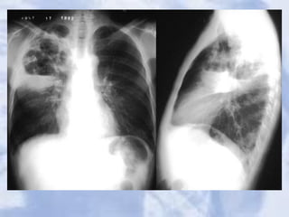 HOW TO READ CXR | PPT
