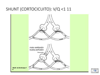 SHUNT (CORTOCICUITO): V/Q <1 11
 