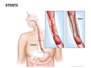 STENTS
 