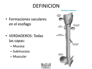 DEFINICION
• Formaciones saculares
en el esofago
• VERDADEROS: Todas
las capas:
– Mucosa
– Submucosa
– Muscular
 