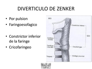 DIVERTICULO DE ZENKER
• Por pulsion
• Faringoesofagico
• Constrictor inferior
de la faringe
• Cricofaringeo
 