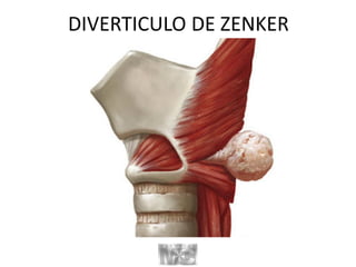 DIVERTICULO DE ZENKER
 