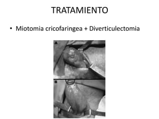 TRATAMIENTO
• Miotomia cricofaringea + Diverticulectomia
 
